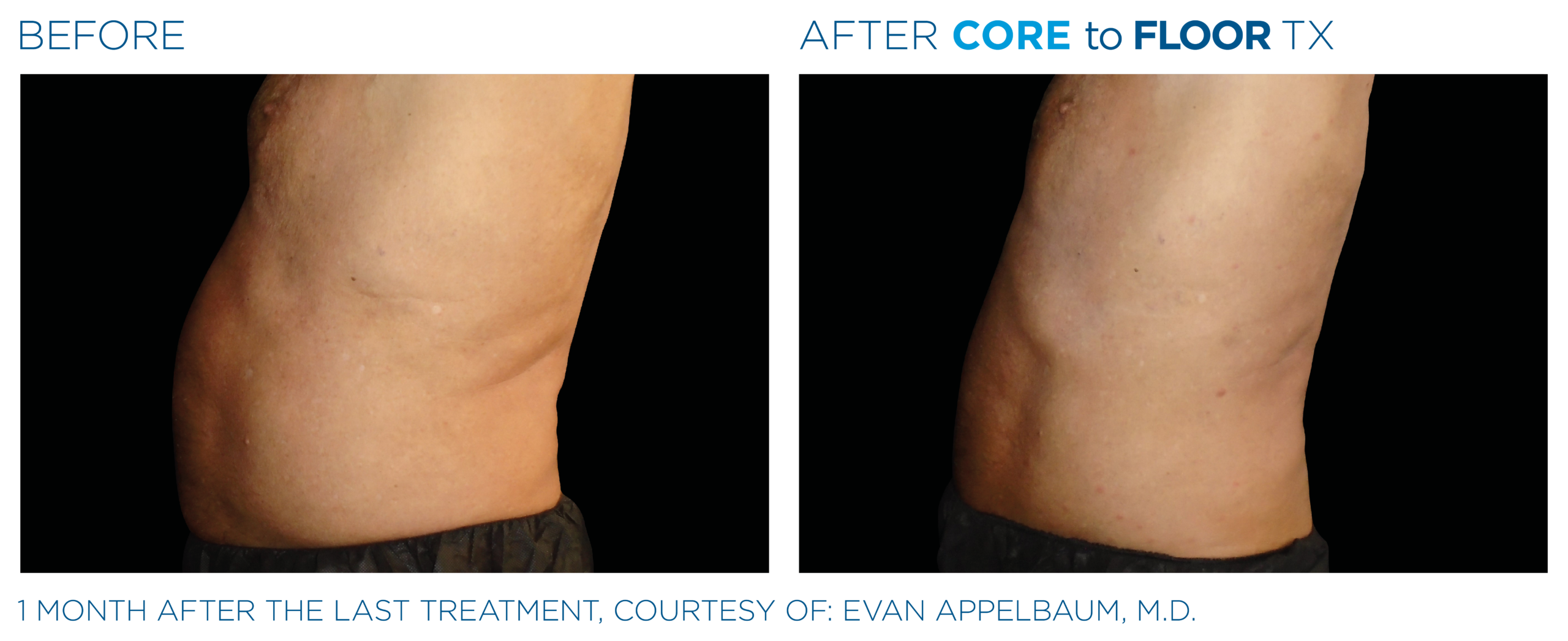 emsculpt neo emsella pic ba card male abdomen 024 enus100