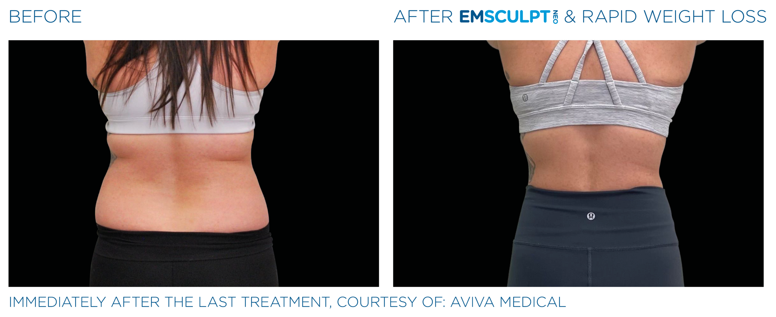 emsculpt neo weight loss pic ba card female lateral abdomen 014 enus100